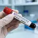 Epidemia chorób wenerycznych w Europie. Przyczyny i 17 najczęstszych chorób.  Wykład nr. 239